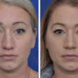 Septoplasty and Rhinoplasty